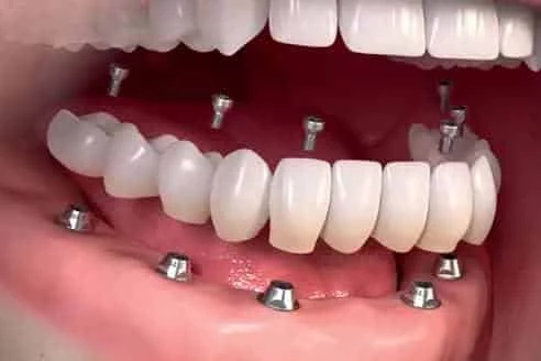 beverly hills dentist